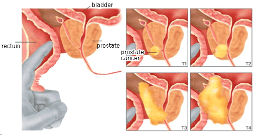 T Stages of Prostate Cancer